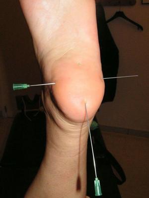 16P Naked blond is tortured with needles and electricity while in bondage